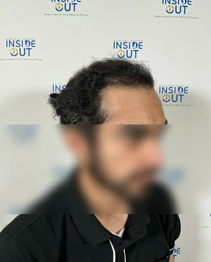 Hair Transplant before and after result