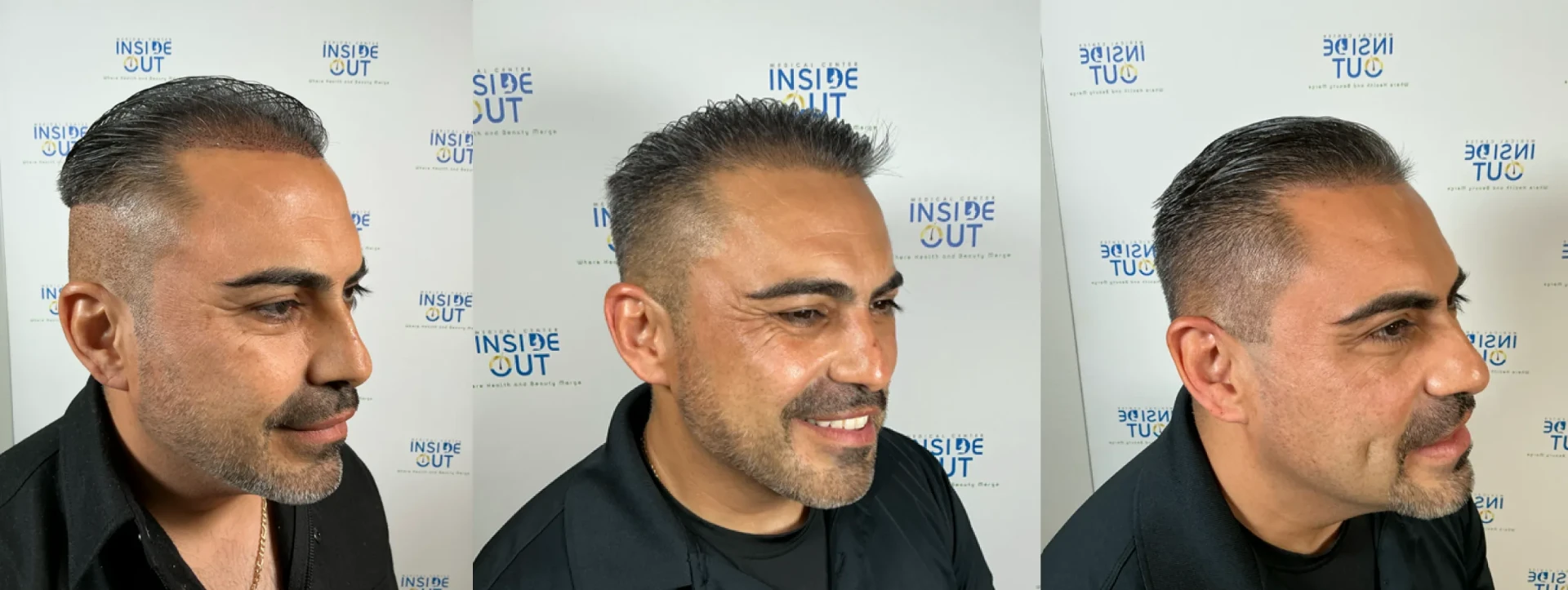 Hair Restoration before and after result