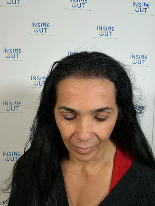 Women's Hair Restoration before and after result
